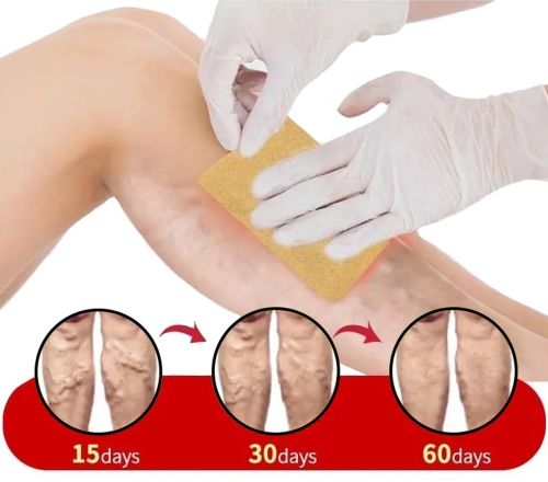 Тілесний пластир від варикозу KanyeHB Varicose Veins Plaster 6 шт, Комплект патчів від варикозного розширення вен і васкуліту, антиварикозні пластирі