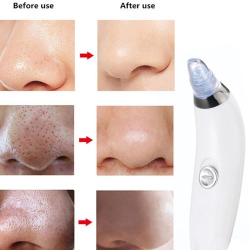 Вакуумний апарат Derma Suction прилад для чищення пір і видалення чорних крапок, пілінг для обличчя, очищувач, апарат-Очищувач шкіри 4 насадки Білий